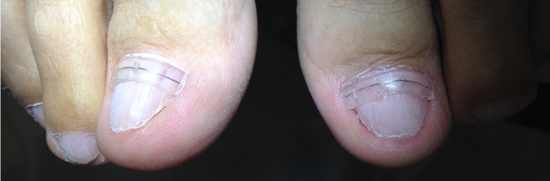 pedicure